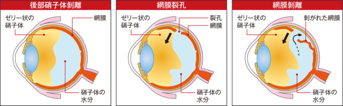 「症状」が急激に変化したら「網膜剝離」を疑い専門医へ!