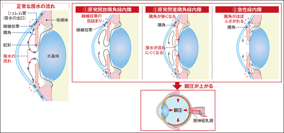 自覚症状に乏しい緑内障 「高齢者」「近視」は要注意！