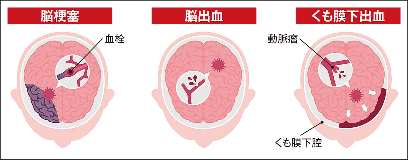 脳 動脈 瘤 原因 ストレスについて : 動脈血栓症に関する医師への質問445件 – MJVTB